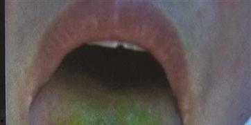 吃瓜后舌头刺痛,原因及应对方法